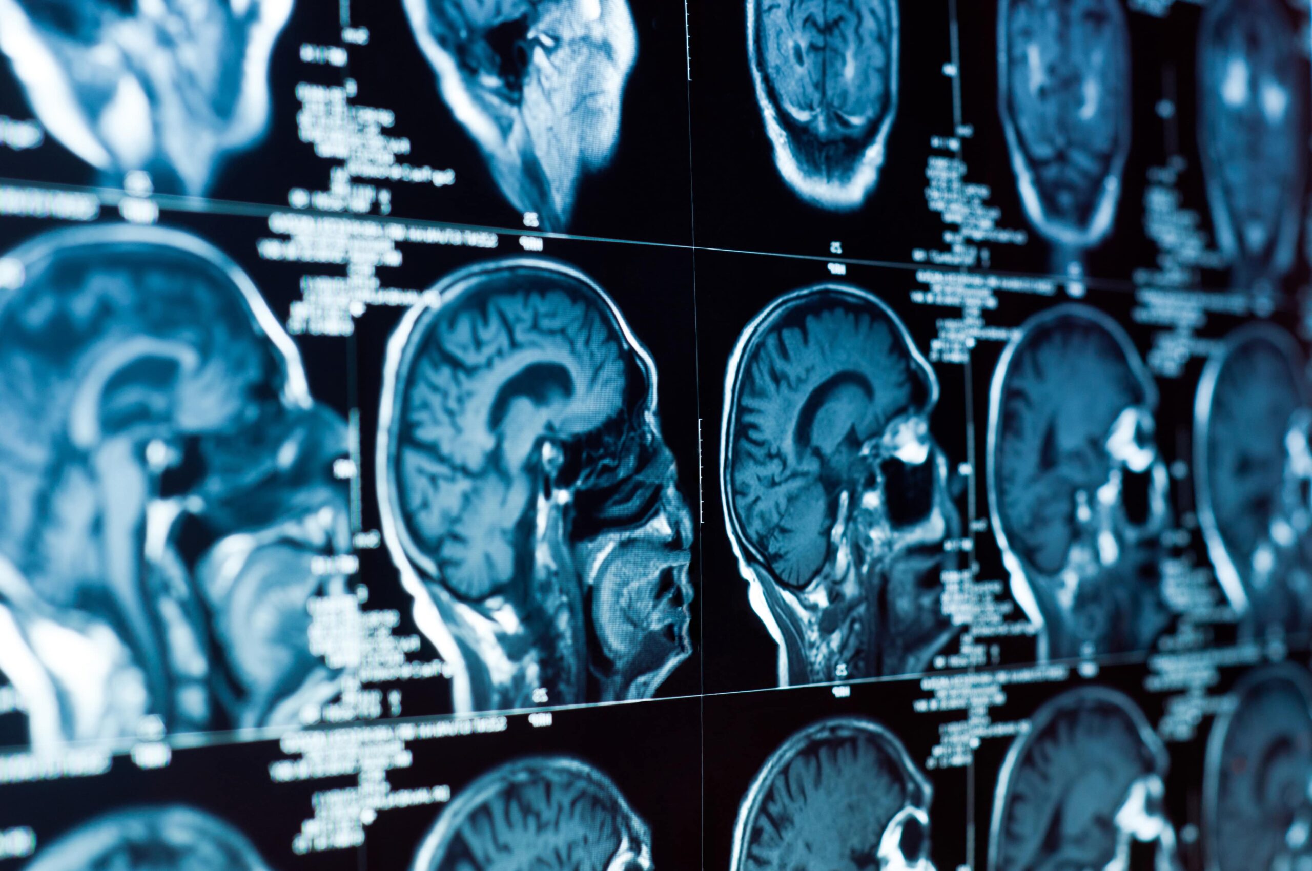 Read more about the article The Legal Aftermath Of Brain Injuries